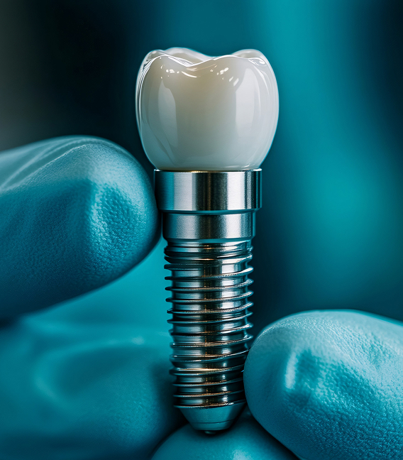 Dental Implant